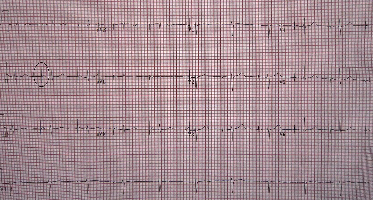 An ECG in a person with a single-chamber pacemaker to the atrium. Note the circle around one of the sharp electrical spi