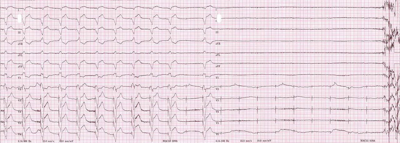 ECG rhythm strip of a threshold determination in a patient with a temporary (epicardial) ventricular pacemaker. The epic