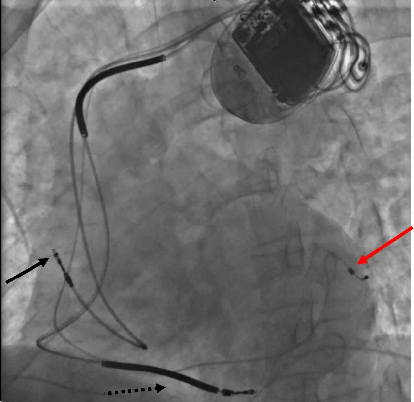 Three leads can be seen in this example of a cardiac resynchronization device: a right atrial lead (solid black arrow), 