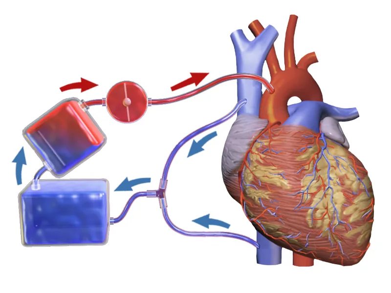 Illustration of one typical way that a heart-lung machine may be connected to the veins and arteries near the heart. The