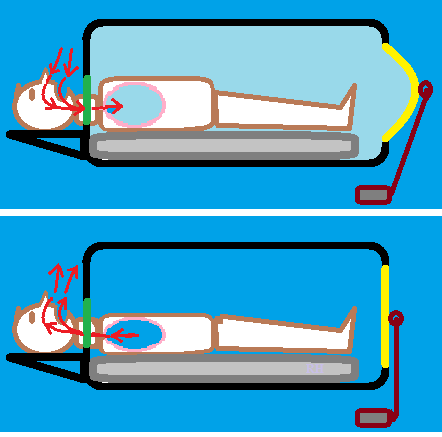 An iron lung cylinder (black) showing the patient’s head exposed through a sealed opening. The diaphragm (yellow) mechan