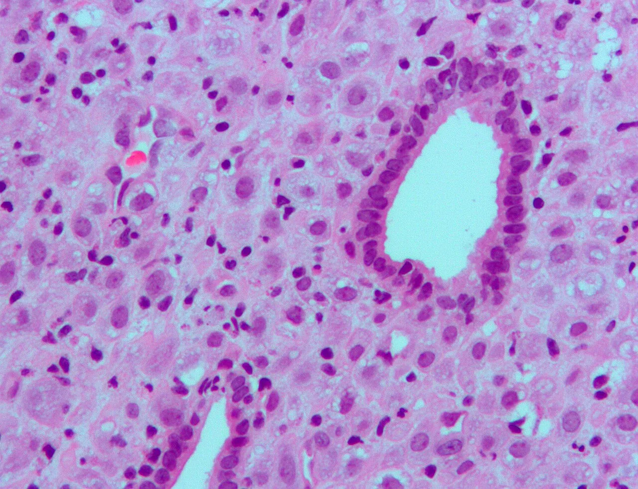 Micrograph showing changes to the endometrium due to progesterone (decidualization) H&E stain