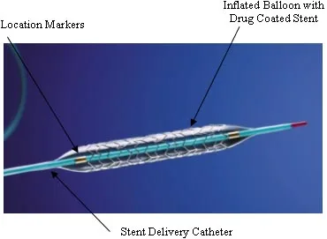 A balloon-expandable coronary stent on a balloon catheter