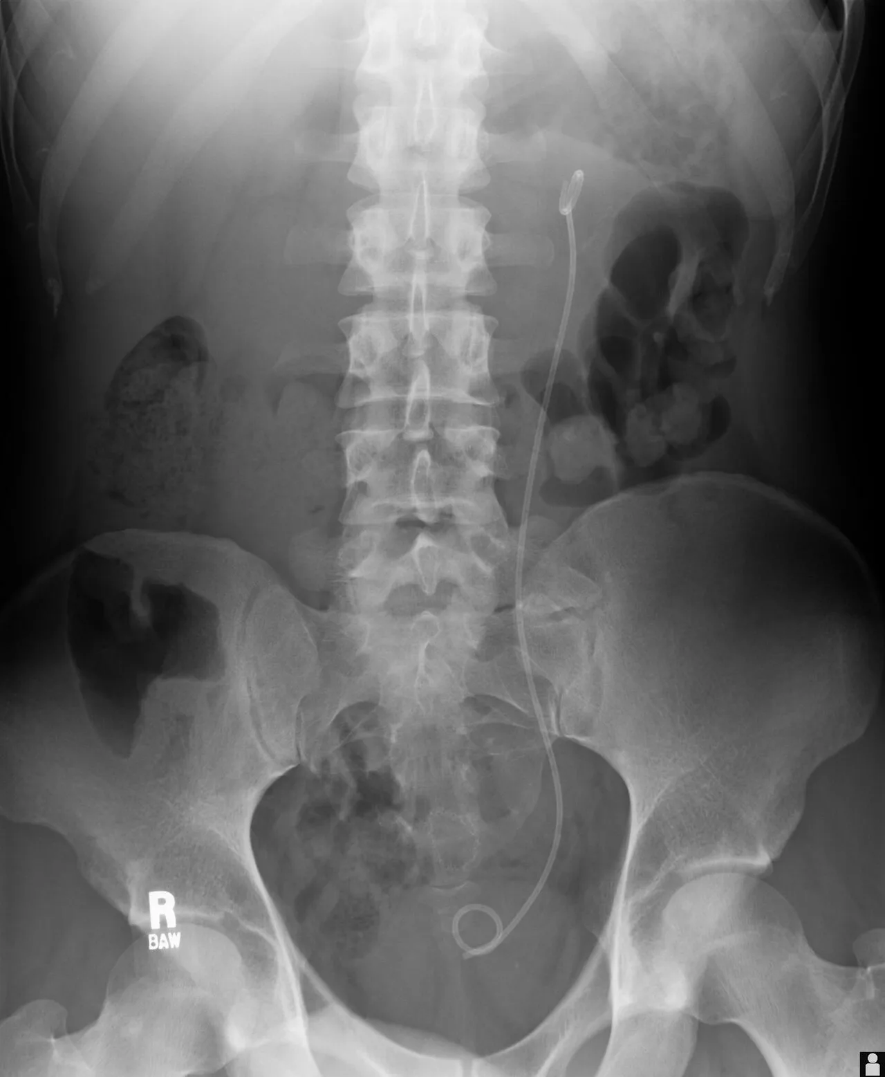 Example of a ureteral stent used to alleviate hydronephrosis of the kidney