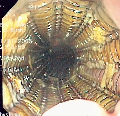 Endoscopic image of a self-expanding metallic stent in an esophagus, used to palliatively treat esophageal cancer